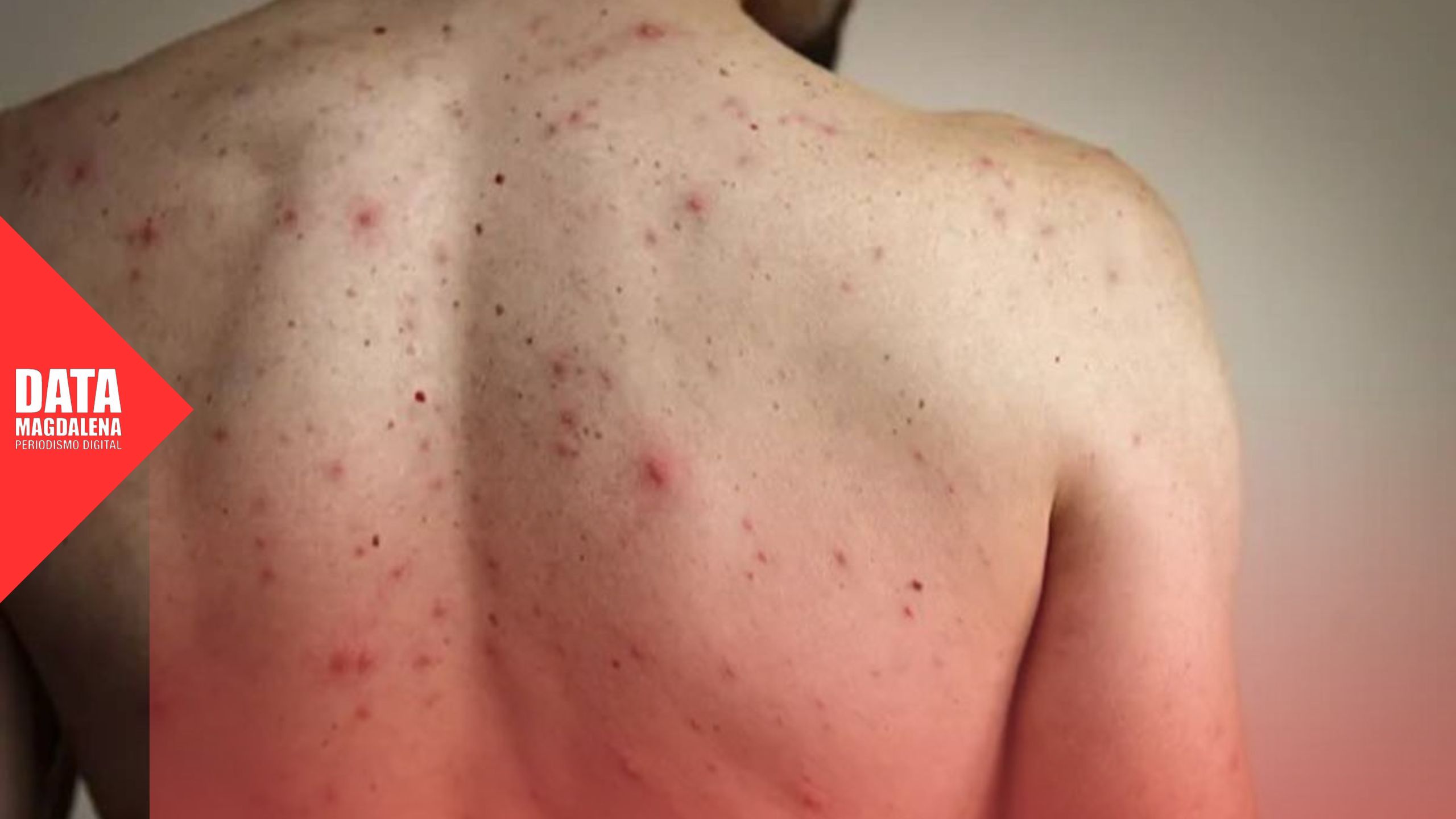 Crece el alerta por sarampión y Kreplak señala fallas en control sanitario nacional